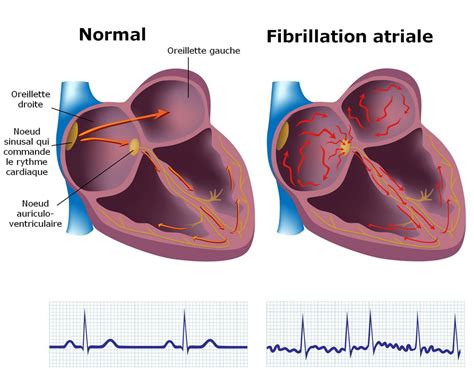 fibrillation auriculaire in english.